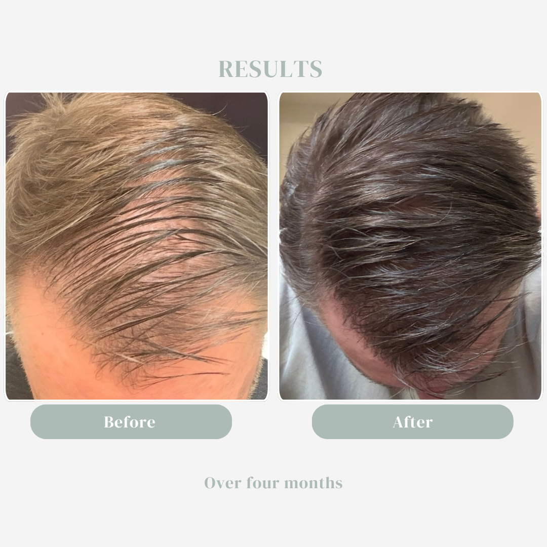 What is pattern thinning?