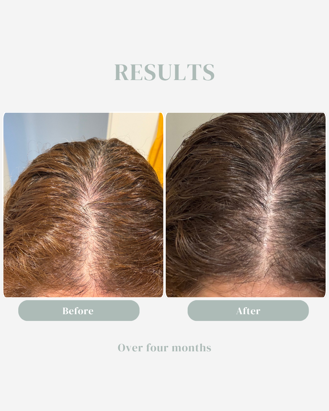 The Scalp System for thinning & hair growth